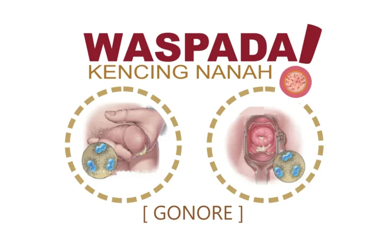 obat kencing nanah
